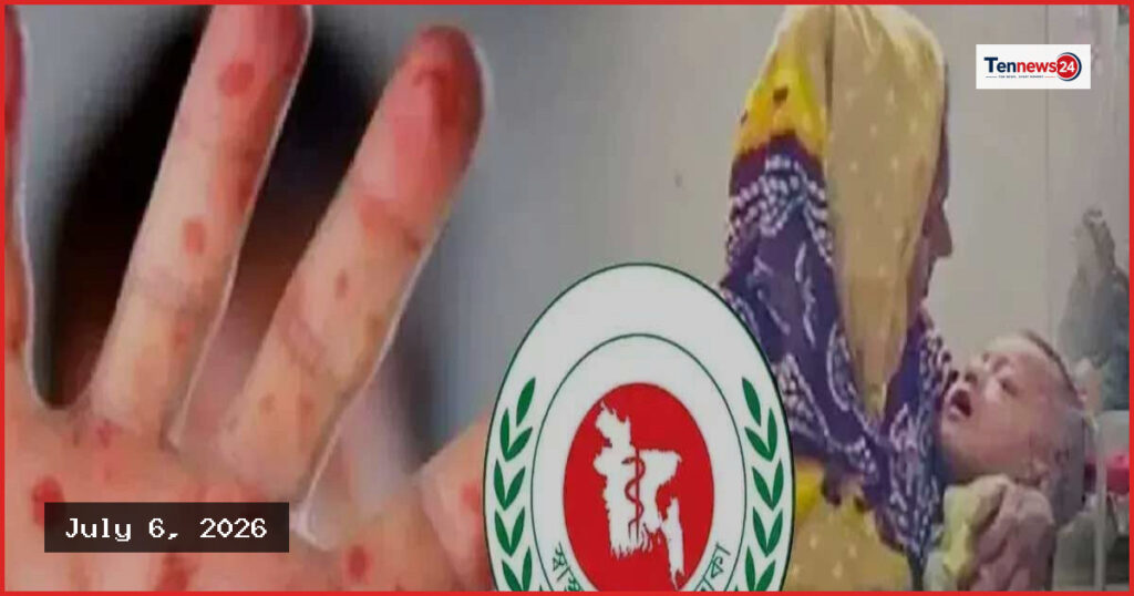 দেশে হাম ও উপসর্গে আরও তিন শিশুর মৃত্যু