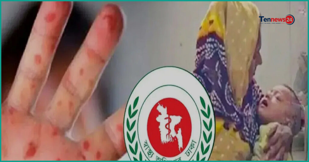 দেশে হাম ও উপসর্গে আরও ৬ শিশুর মৃত্যু
