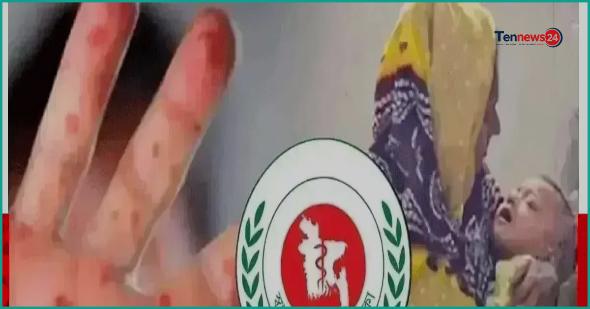 দেশে হামের উপসর্গে আরও চার শিশুর মৃত্যু