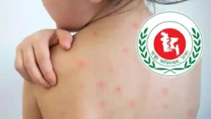 দেশে হামের প্রকোপ ও ঝুঁকি