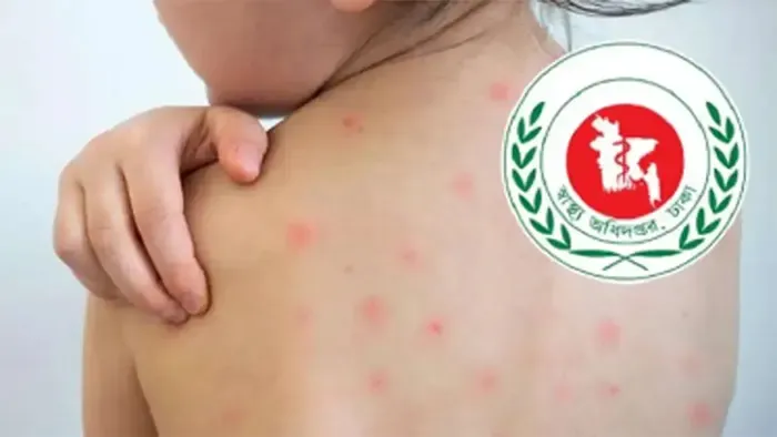 দেশে হামের প্রকোপ ও ঝুঁকি