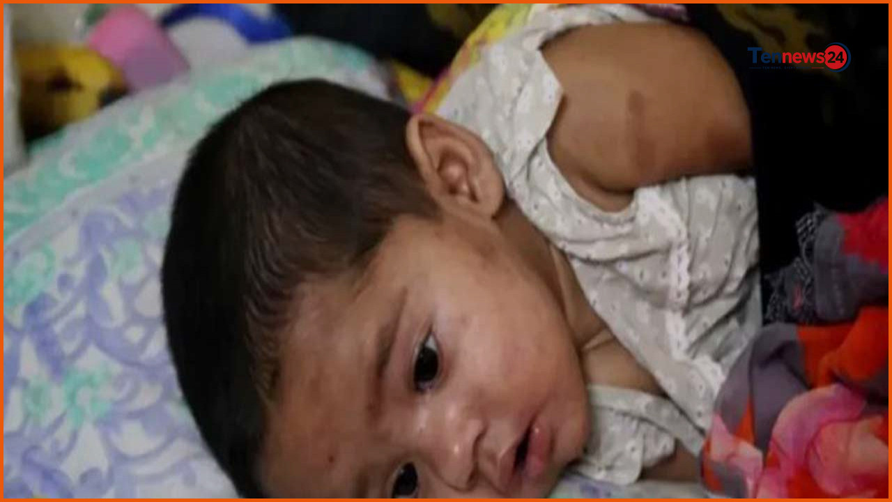 সিলেটে হামের প্রকোপে ফের শিশুর মৃত্যু, হাসপাতালে ভর্তি ১৫৩