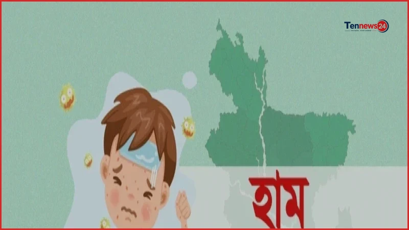 হাম ও উপসর্গে দেশে মোট মৃত্যু ৯৮৭ জন